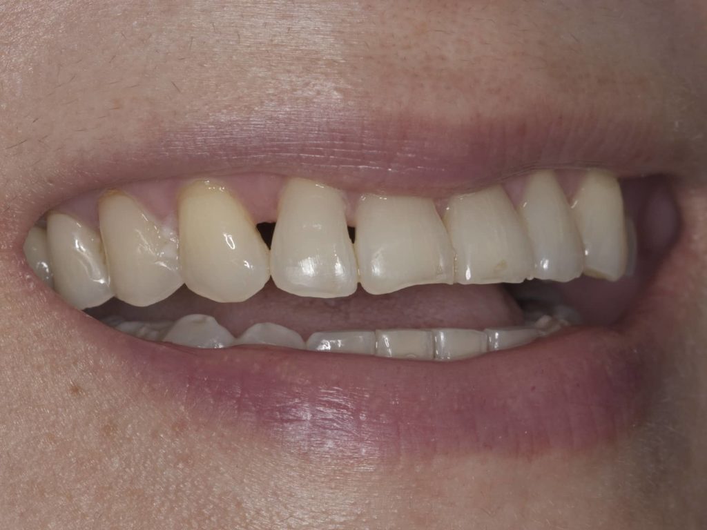 Black Triangles Between Teeth