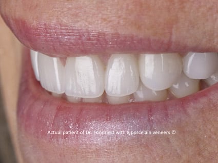 photo of Porcelain crowns and veneers photo of Porcelain crowns and veneers