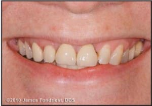 Figure 1. Preoperative appearance displays an uneven occlusal table, asymmetric gingival display, and varied color, texture, and opacities.