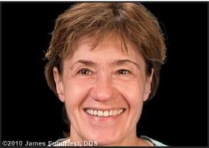 Figure 2. Patient appearance at initial presentation with facial and dental asymmetries.