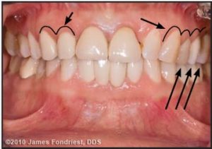 Figure 3. The occlusal plane hung down on left side and the axial inclination of the central incisors was slanted.