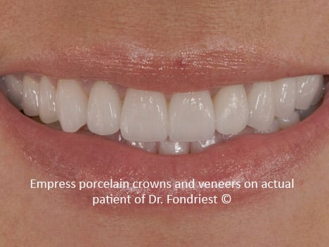 Empress porcelain crowns and veneers Empress porcelain crowns and veneers