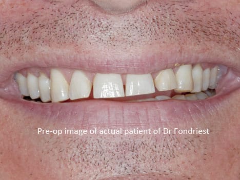 image of tooth grinder with bruxism image of tooth grinder with bruxism