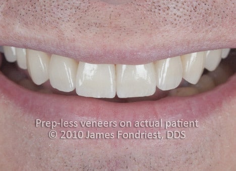 image of Prep-less veneers image of Prep-less veneers