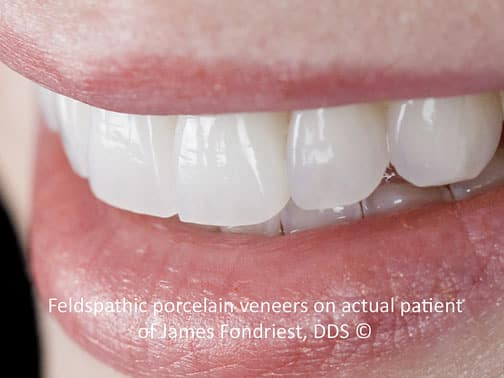 Feldspathic Veneers Feldspathic porcelain veneers