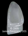 Feldspathic veneers with contact lens effect Example of a feldspathic laminate