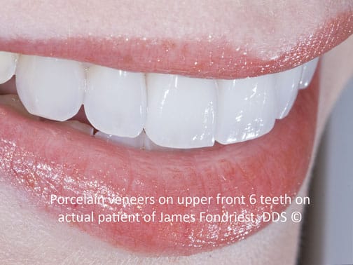 "Stacked feldspathic veneers" Brighter Teeth