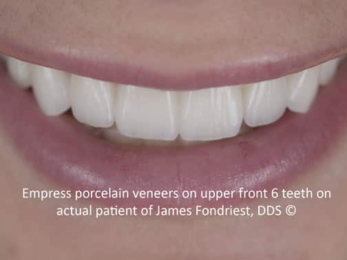Example of Empress Veneers Empress veneers