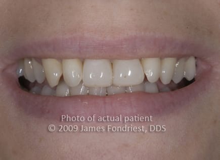 poorly done composite veneers poorly done composite veneers