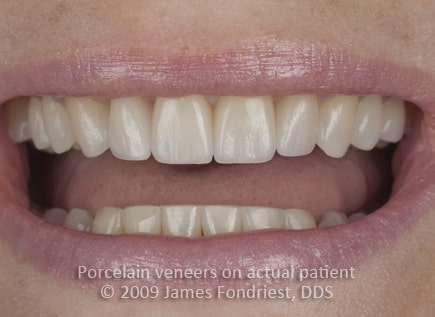 E Max porcelain veneers, Veneers as alternative to orthodontics E Max porcelain veneers, Veneers as alternative to orthodontics