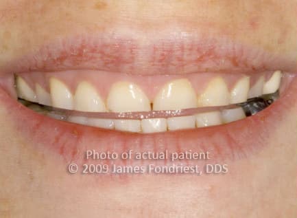 Shortened teeth from nighttime bruxism, tooth grinding Shortened teeth from nighttime bruxism, tooth grinding