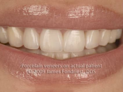 Porcelain veneers used to lengthen teeth Porcelain veneers used to lengthen teeth