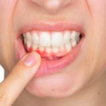 getting to know gingivitis