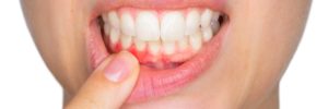 getting to know gingivitis
