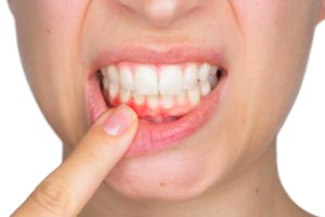 getting to know gingivitis