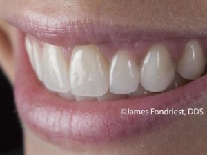 dental bridge vs implant