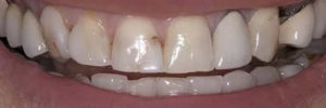 Dental health changes with age