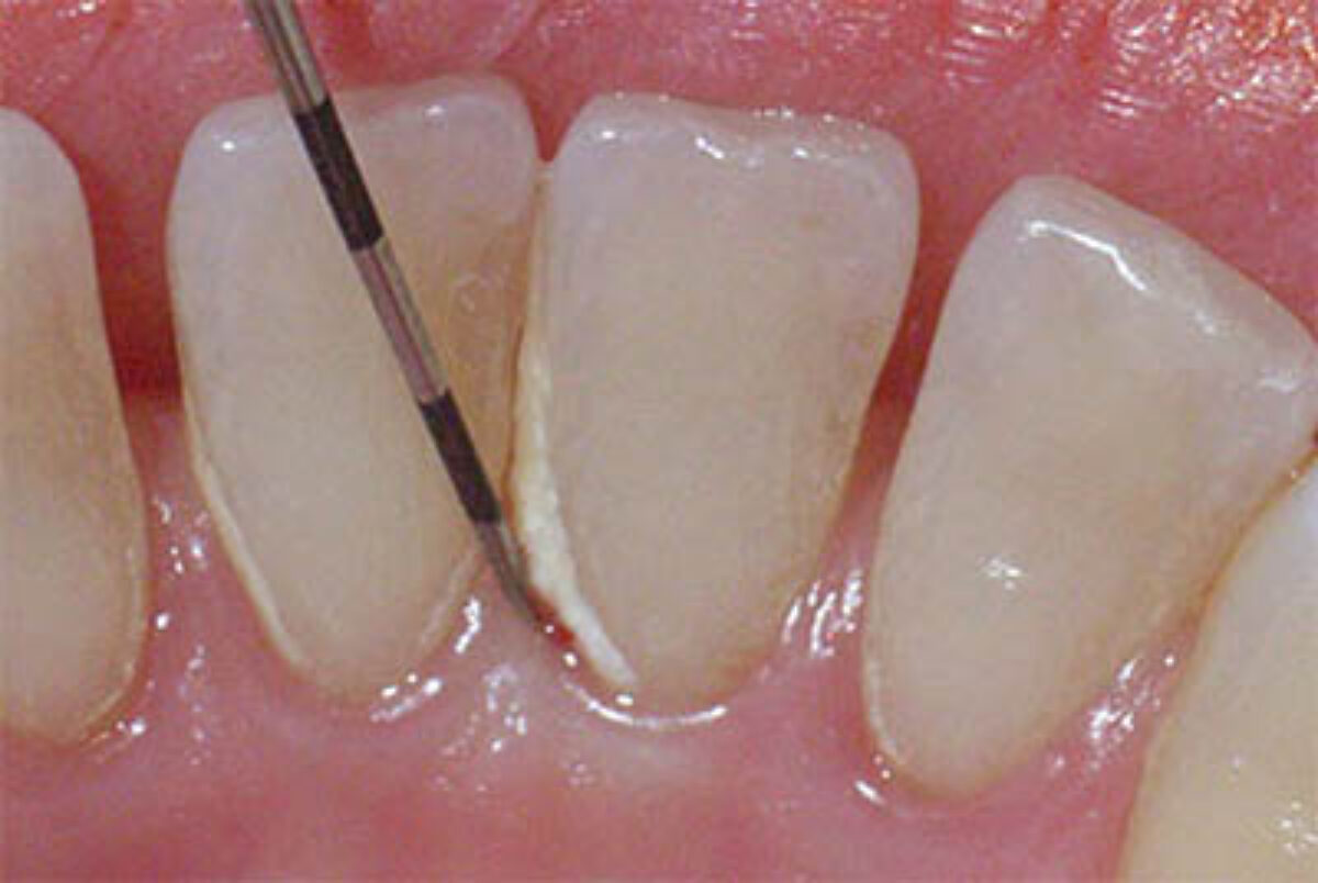 plaque teeth