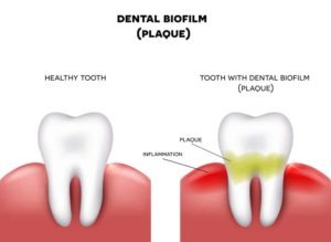 digital illustration of dental plaque