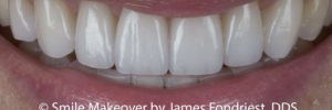 Full-Mouth Reconstruction