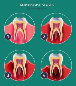 stages of gum disease vector