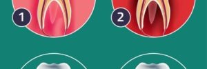 stages of gum disease vector