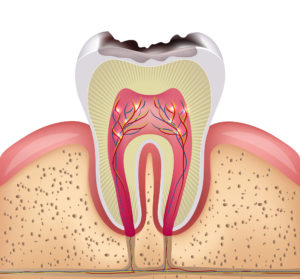 dental cavities