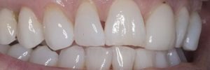 Triangular spaces between Teeth