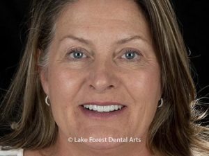 Are teeth implants worth it?