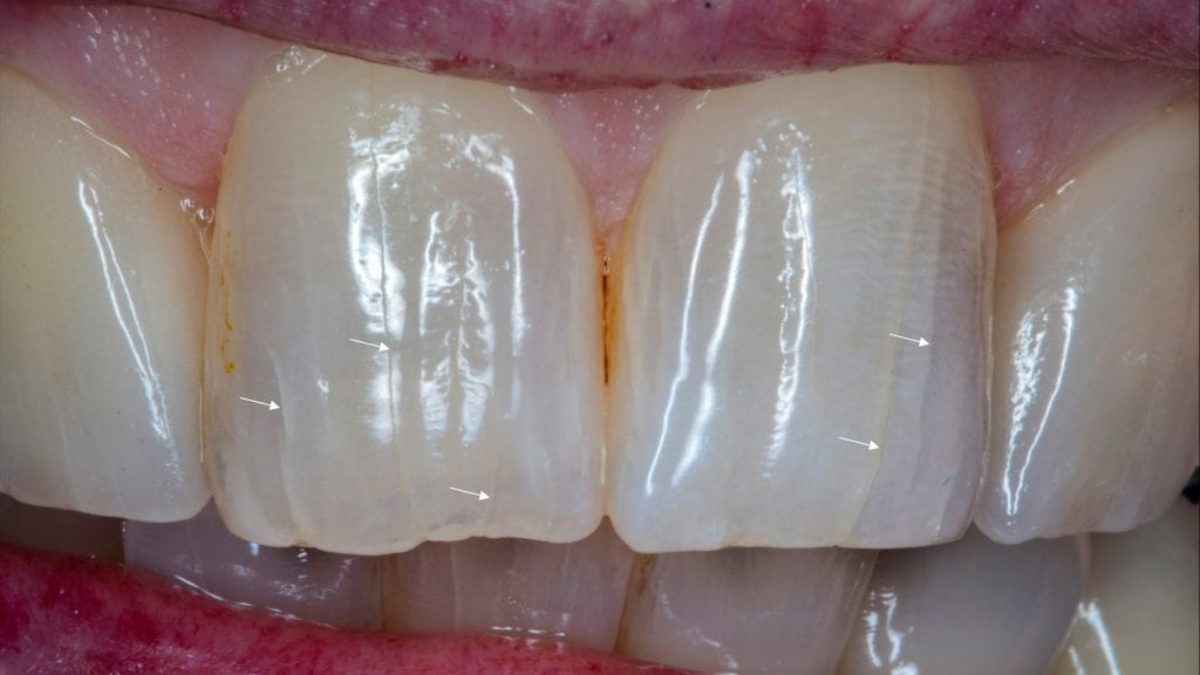 Jonathan S Dean DDS - What are craze lines? Craze lines are minute vertical  lines that form on the teeth. Cracked teeth and craze lines are often  confused for each other; however