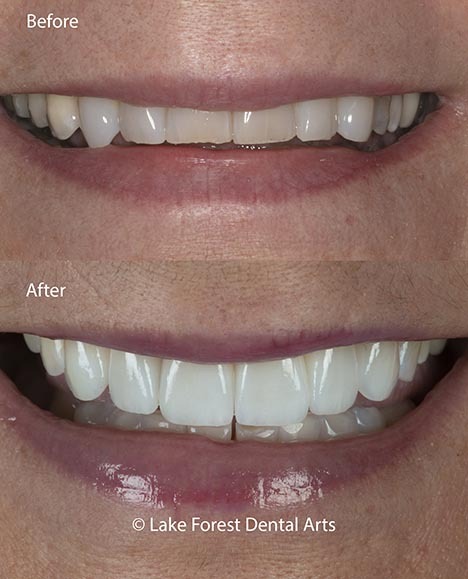 prepless veneers before and after