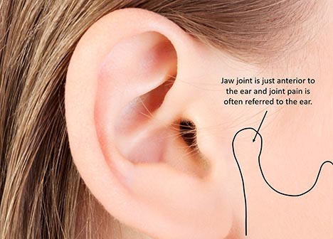 TMJs refer pain to ears