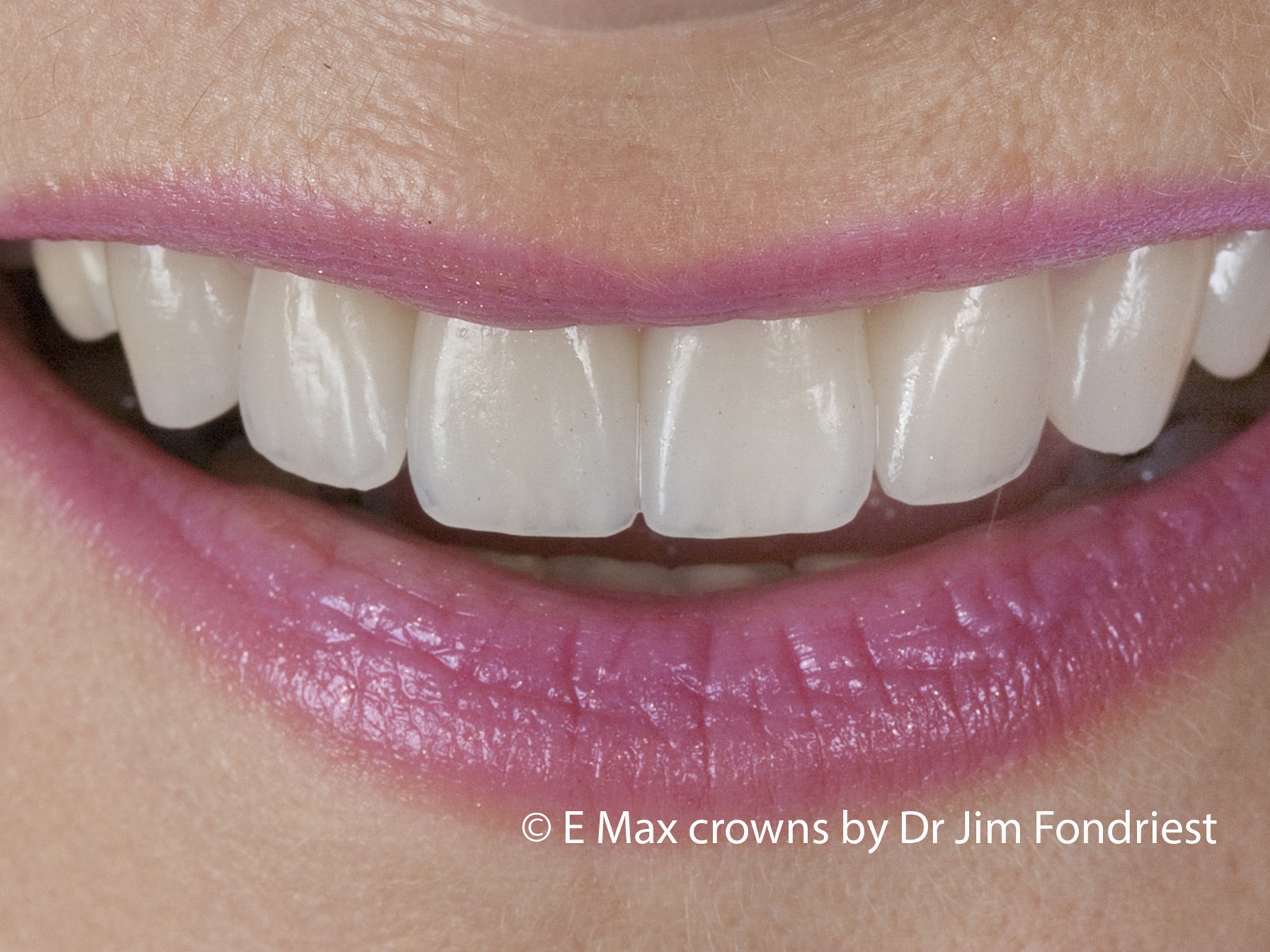 Best Porcelain Crowns
