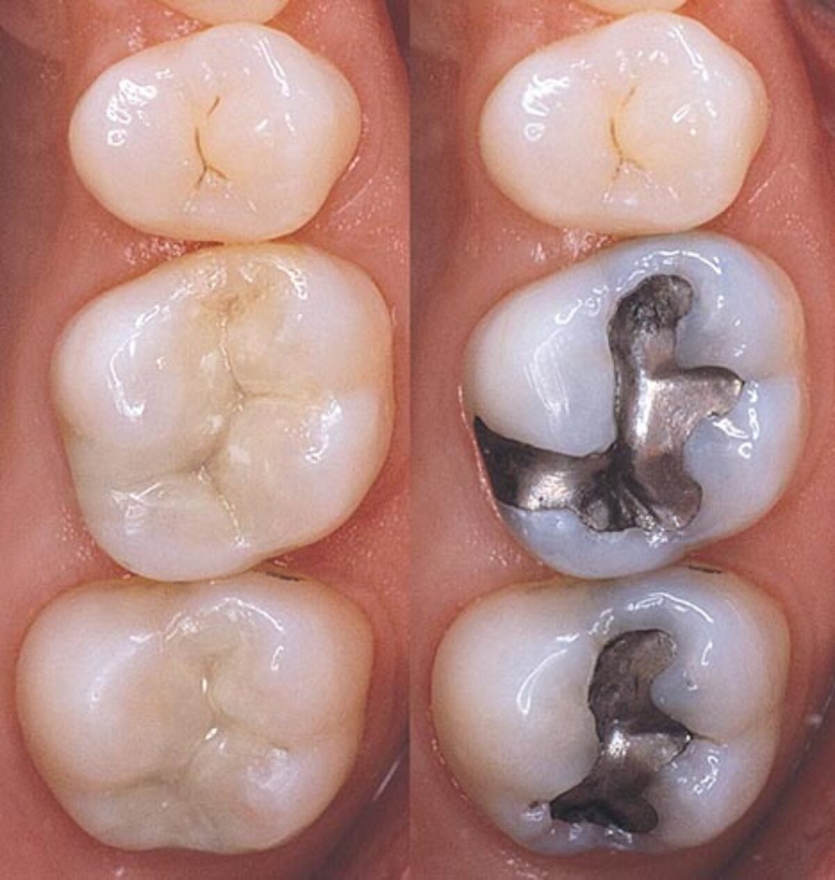 Tooth Fillings