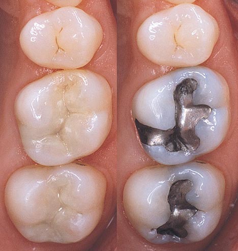 What is the Difference Between White Fillings and Silver Fillings