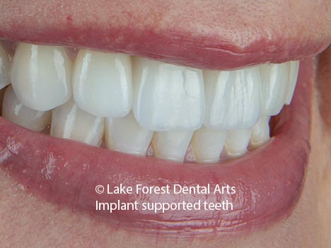 tooth replacement with a dental implant