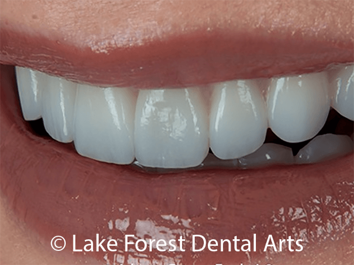 Cosmetic tooth coverings