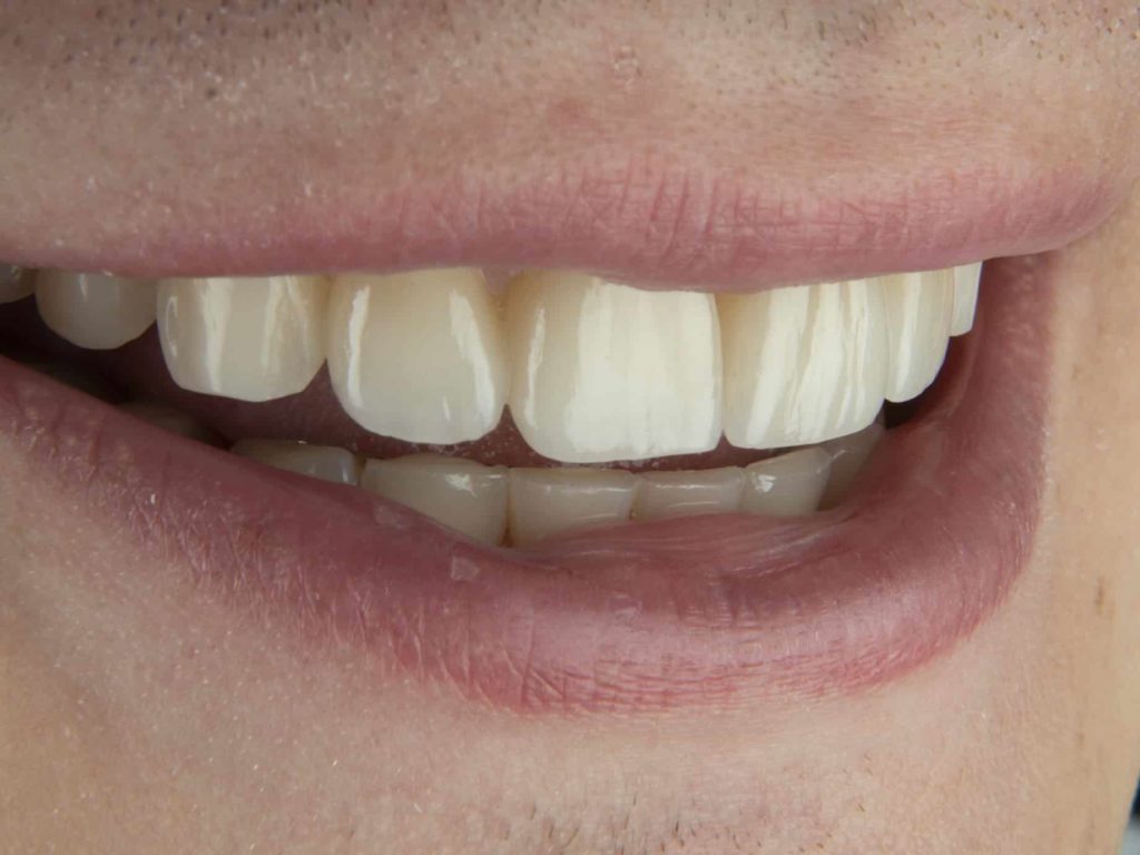 Lake Forest Dentist The Benefits of Porcelain Crowns