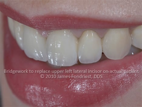 POM / PFM fixed partial retainer, missing tooth replacement, ovate pontic This patient was missing her left lateral incisor or the second complete tooth visible from the right. There was not enough room for an implant so permanent PFM bridgework was created. Special attention was given to make a specific shape to the underside of the false tooth (ovate pontic) so that it would appear like a natural tooth growing out of the gum. Matching the surface textures of the other natural teeth was also a challenge.
