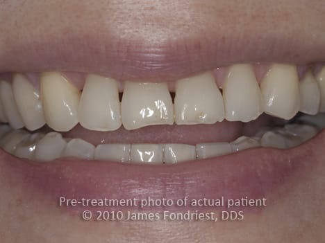 teeth between triangles gaps before veneers fill porcelain spaces lakeforestdentalarts