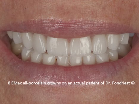 Improving shape and symmetry with EMax crowns E Max Restorations