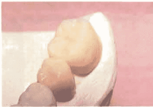 Figure 2. Diagnostic wax-up of planned restoration using Triad composite.