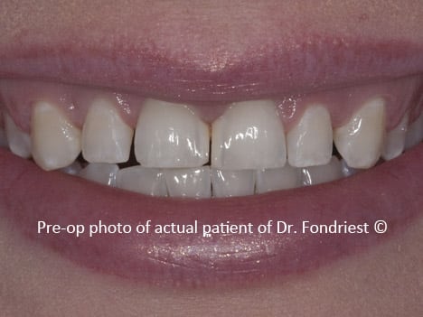 spaces between teeth, diastemas, gapped teeth