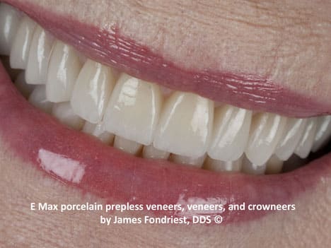 Mixed Conservative - low preparation veneers The demographics of smile makeovers is changing very quickly nationwide. Smile makeovers are no longer solely the domain of 30 to 40 year olds. Now we are finding more of our elective cosmetic cases are being requested by women over the age of 50. This patient always wanted a beautiful smile and finally at age 77, asked for it! Most of the upper teeth in this photograph are covered by thin sheaths of ceramic fashioned to create the contours that this very sophisticated client from Chicago's Gold Coast requested. See the before and after photos of this patient who was also a bruxer (had worn teeth due to nightime tooth grinding).