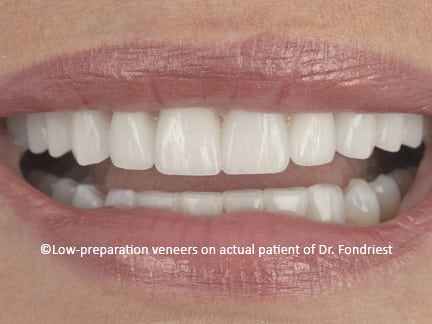 Prepless Veneers to change shape of teeth Ten conservative porcelain veneers were placed on the upper teeth of this Gurnee patient. "Additive only veneers" were used to change the shapes and to remove the color blemishes of her teeth.