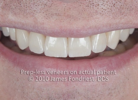Seven low-preparation veneers used to lengthen teeth and to fill gaps Seven veneers with only a small amount of enamel removal were done on the upper front teeth were done to lengthen them and to fill the gaps or spaces between his teeth and to broaden the smile.