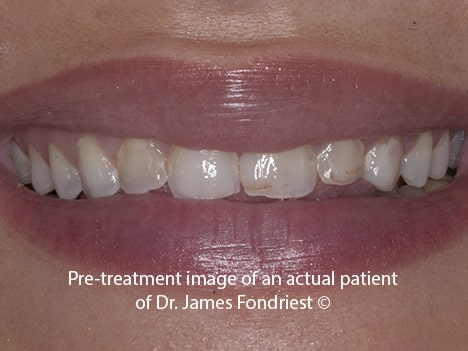 Resin bonding increases tooth length for short teeth