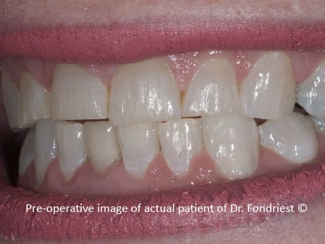 Chipped and worn teeth of a person who bruxes