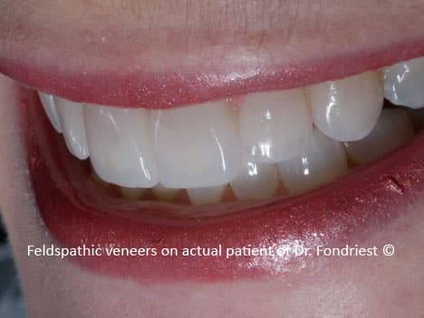 6 Feldspathic veneers on grinder