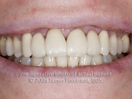 opaque porcelain bridgework, correction of angled teeth, unnatural dentistry bridges opaque porcelain bridgework, correction of angled teeth, unnatural dentistry bridges